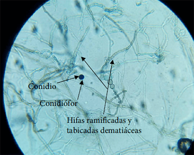 Figura 3. Examen directo de la colonia con azul de Cotton (40 X) donde se observa un conidio solitario esférico de color negro sobre un conidióforo ligeramente abultado e hifas ramificadas y tabicadas dematiáceas compatibles con Nigrospora sp.