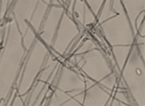 Figura 1. Hifas hialinas tabicadas y blastoconidias ovaladas provenientes de la muestra # 2 (liquido denso) examen al fresco con KOH al 20%.