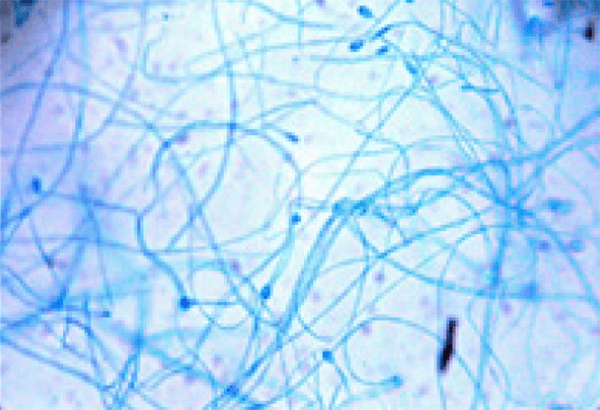 Figura 3. Examen directo de la colonia proveniente del PDA con azul de Cotton, se observan hifas hialinas tabicadas y conidios en solitario redondeados, compatibles con el complejo S. apiospermun.