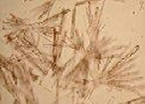 Figura 10. Agregado de cristales de Sulfato de calcio (400X, microscopia Óptica de luz). Fuente: Mundt, Lillian; Shanahan, Kristy. Graff. Análisis de orina y de los líquidos corporales. México: Panamericana; 2011.