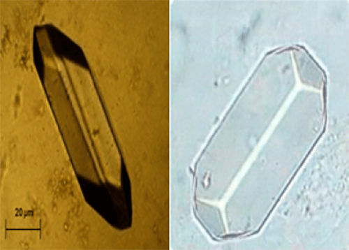 Figura 11. Típico cristal de estruvita en forma de ataúd (400X, microscopia óptica de luz). Fuente: Michel Daudon, Vincent Frochot, Dominique Bazin, Paul Jungers. Crystalluria analysis improves significantly etiologic diagnosis and therapeutic monitoring of nephrolithiasis . Comptes Rendus Chimie. 2016; 19 (11–12): 1514-1526.