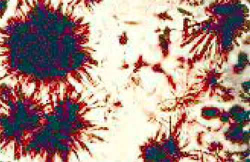 Figura 15. Cristales de tirosina (400X, microscopia óptica de luz). Fuente: Mundt, Lillian; Shanahan, Kristy. Graff. Análisis de orina y de los líquidos corporales. México: Panamericana; 2011