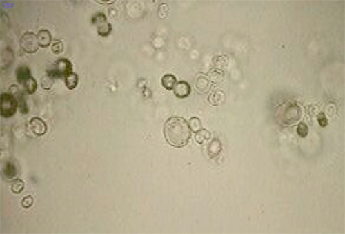 Figura 16. Cristales de leucina (400X, microscopia óptica de luz). Fuente: Mundt, Lillian; Shanahan, Kristy. Graff. Análisis de orina y de los líquidos corporales. México: Panamericana; 2011.