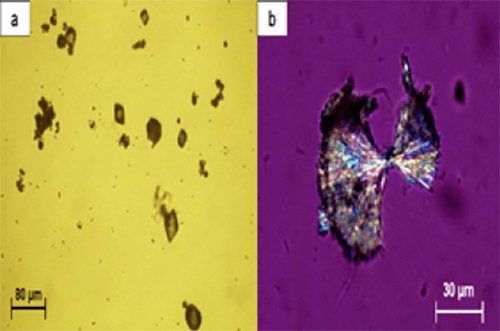 Figura 17. (a) Cristales de hidrocloruro de N-acetilsulfametoxazol que se asemejan a cristales de ácido úrico deshidratado (400X, microscopía óptica de luz). (b) Cristales agregados de N-acetilsulfadiazina (400X microscopía polarizada). Fuente: Michel Daudon, Vincent Frochot, Dominique Bazin, Paul Jungers. Crystalluria analysis improves significantly etiologic diagnosis and therapeutic monitoring of nephrolithiasis . Comptes Rendus Chimie. 2016; 19 (11–12): 1514-1526.