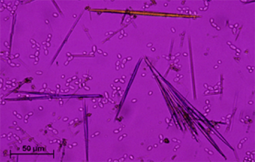 Figura 18. Cristales de amoxicilina (400X, microscopía polarizada). Fuente: Michel Daudon, Vincent Frochot, Dominique Bazin, Paul Jungers. Crystalluria analysis improves significantly etiologic diagnosis and therapeutic monitoring of nephrolithiasis . Comptes Rendus Chimie. 2016; 19 (11–12): 1514-1526