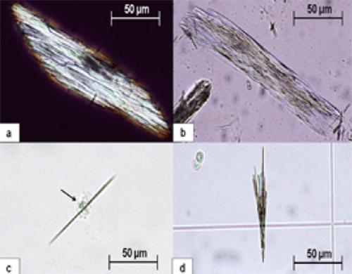 Figura 19. Cristales de fármacos antiproteasas utilizados para tratar pacientes con VIH. (A) y (b) Agregados de cristales de monohidrato de indinavir (400X, microscopia polarizada). (C) y (d) Cristales en forma de aguja de atazanavir (400X, microscopia óptica de luz). Los cristales se asocian comúnmente con células blancas(flecha). Fuente: Michel Daudon, Vincent Frochot, Dominique Bazin, Paul Jungers. Crystalluria analysis improves significantly etiologic diagnosis and therapeutic monitoring of nephrolithiasis. Comptes Rendus Chimie. 2016; 19 (11–12): 1514-1526