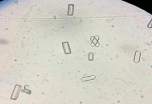 Figura 2. Cristales de ácido hipúrico (400X, microscopia óptica de luz). Fuente: Mundt, Lillian; Shanahan, Kristy. Graff. Análisis de orina y de los líquidos corporales. México: Panamericana; 2011.