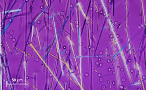 Figura 20. Cristales de aciclovir en forma de aguja (400X, microscopia polarizante). Fuente: Michel Daudon, Vincent Frochot, Dominique Bazin, Paul Jungers. Crystalluria analysis improves significantly etiologic diagnosis and therapeutic monitoring of nephrolithiasis . Comptes Rendus Chimie. 2016; 19 (11–12): 1514-1526