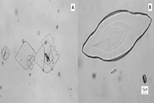 Figura 22. Cristales de ácido úrico. (A)Tamaño mediano (40-50 µm) (400X, microscopía interferencial). (B) Tamaño gigantesco (longitud eje mayor >150 µm) que se asocia significativamente con hiperuricosuria y litiasis (200X, microscopía interferencial). Fuente: Dalet, Fernando. El sedimento urinario: ¿qué hay de nuevo en algo tan viejo?. Act Fund Puigvert 1999;18(3):135-48.
