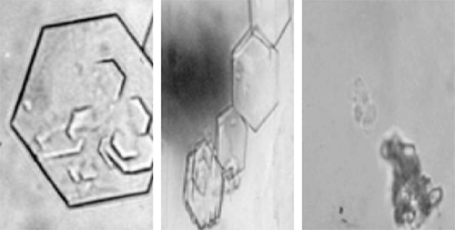 Figura 23. Cristales de Cistina (400X, microscopia inferencial). Pequeño (15-20 µm), mediano (50-60 µm) y grande (>100 µm). En este caso concreto, la determinación del tamaño y número se utiliza para controlar la eficacia del tratamiento farmacológico. Fuente: Dalet, Fernando. El sedimento urinario: ¿qué hay de nuevo en algo tan viejo?. Act Fund Puigvert 1999;18(3):135-48