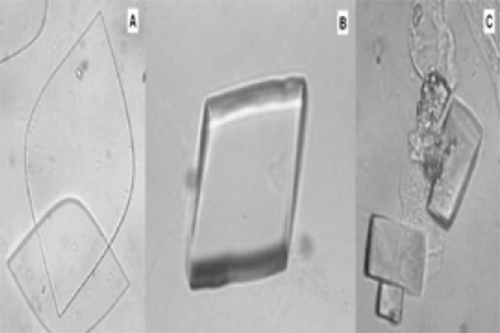 Figura 25. Cristales de ácido úrico (400X, microscopia inferencial). (A) Cristal de ácido urico “fino”, en el cual no se detecta crecimiento del prisma rombico. (B) Cristal de ácido urico “grueso”. Obsérvese el crecimiento del prisma rombico que puede cifrarse en un espesor de 2-4 µm. (C) Cristal de ácido urico “muy grueso” con un crecimiento del orden de 15 µm. Este aspecto tetragonal al microscopio puede inducir a confusión cuando en realidad lo que sucede es que el cristal al ser tan grueso ha girado 90ºC y descansa sobre una cara rectangular del prisma rombico. Constituye un excelente signo para una valoración patológica de la cristaluria que se asocia metabólicamente a una hiperuricosuria con o sin litiasis. Fuente: Dalet, Fernando. El sedimento urinario: ¿qué hay de nuevo en algo tan viejo?. Act Fund Puigvert 1999;18(3):135-48