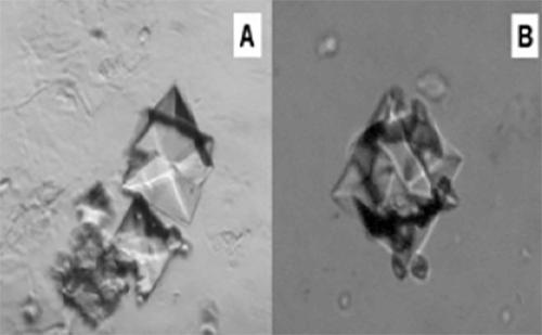 Figura 26. (A) Macla simple (dos unidades cristalinas) gigante de Oxalato cálcico dihidratado (400X, microscopia interferencial). (B). Macla compuesta de al menos 5 unidades cristalinas en crecimiento conjunto (400X, microscopia interferencial). Fuente: Dalet, Fernando. El sedimento urinario: ¿qué hay de nuevo en algo tan viejo?. Act Fund Puigvert 1999;18(3):135-48