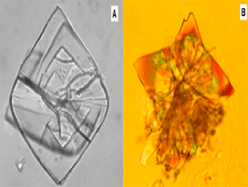 Figura 27. (A) Macla gigante compuesta de ácido urico (400X, microscopia inferencial). (B) Macla gigantesca que acoge a innumerables unidades cristalinas en crecimiento conjunto. Como los hemiromboides están expuestos a la luz polarizada en distintos ángulos adquieren colores de extinción diferentes (200X, microscopia polarizada). Fuente: Dalet, Fernando. El sedimento urinario: ¿qué hay de nuevo en algo tan viejo?. Act Fund Puigvert 1999;18(3):135-48