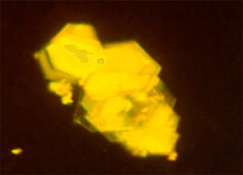 Figura 28. Macla gigante compuesta en estratos o escalera característica de los cristales de Cistina (400X, microscopia polarizada). Constituye un claro significativo signo de riesgo litiasico que se complementa con la existencia de una hipercistinuria >500 mg/24h. Fuente: Dalet, Fernando. El sedimento urinario: ¿qué hay de nuevo en algo tan viejo?. Act Fund Puigvert 1999;18(3):135-48