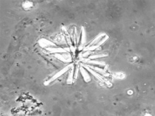 Figura 29. Macla gigante de Brushita (Fosfato cálcico hidrogenado) compuesta por la unión sobre un punto central de los primas monoclínicos (400X, microscopia contrate de fase). Hallazgo caracteristico en los casos de litiasis por Brushita y asociado a hipercalciuria e hiperoxaluria. Fuente: Dalet, Fernando. El sedimento urinario: ¿qué hay de nuevo en algo tan viejo?. Act Fund Puigvert 1999;18(3):135-48