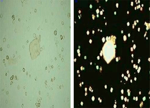 Figura 3. Cristales de ácido úrico (400X, microscopia óptica de luz y polarizada). Fuente: Mundt, Lillian; Shanahan, Kristy. Graff. Análisis de orina y de los líquidos corporales. México: Panamericana; 2011.