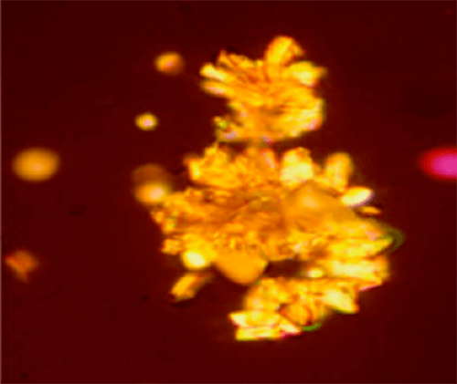 Figura 31. Agregado gigantesco (alrededor de 500 µm) de cristales de ácido urico (100X, microscopia polarizada). Muy alto riesgo litogeno. Fuente: Dalet, Fernando. El sedimento urinario: ¿qué hay de nuevo en algo tan viejo?. Act Fund Puigvert 1999;18(3):135-48