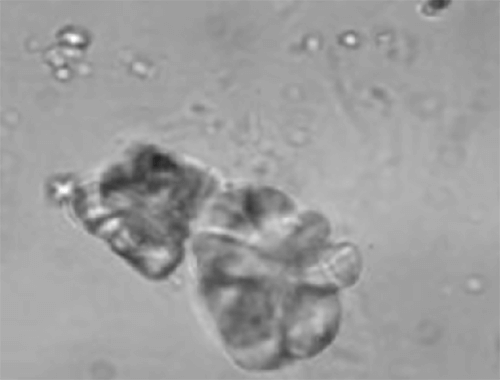 Figura 32. Agregado de maclas de Oxalato cálcico monohidratado (400X, microscopia polarizada). Muy relacionado con litiasis e hiperoxalurias. Fuente: Dalet, Fernando. El sedimento urinario: ¿qué hay de nuevo en algo tan viejo?. Act Fund Puigvert 1999;18(3):135-48.