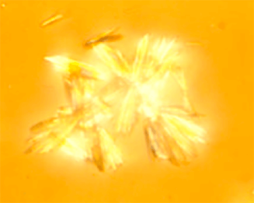 Figura 33. Agregado gigantesco de maclas de Indinavir (100X, microscopia polarizada). Su visión constituye el máximo riesgo para una litiasis. Fuente: Dalet, Fernando. El sedimento urinario: ¿qué hay de nuevo en algo tan viejo?. Act Fund Puigvert 1999;18(3):135-48.