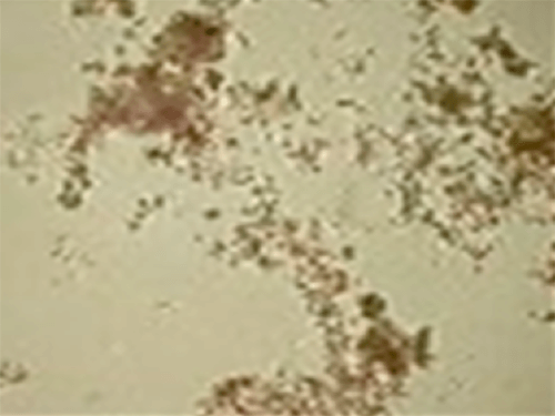 Figura 4. Urato amorfo (400X, microscopia óptica de luz). Fuente: Mundt, Lillian; Shanahan, Kristy. Graff. Análisis de orina y de los líquidos corporales. México: Panamericana; 2011.