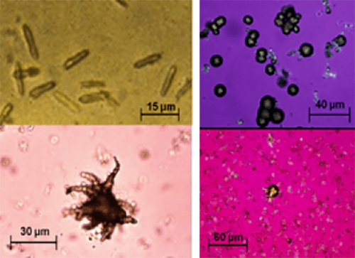 Figura 5. Varias formas de cristales de urato anhídrido hidrógeno de amonio (biurato de amonio) (400X y 100X, microscopia óptica de luz y polarizada). Fuente: Michel Daudon, Vincent Frochot, Dominique Bazin, Paul Jungers. Crystalluria analysis improves significantly etiologic diagnosis and therapeutic monitoring of nephrolithiasis . Comptes Rendus Chimie. 2016; 19 (11–12): 1514-1526.