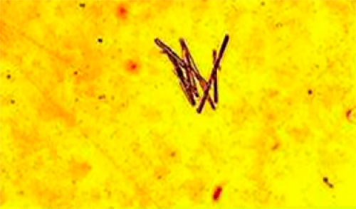 Figura 6. Cristales de urato de hidrógeno de sodio (urato monosódico) (400X, microscopia óptica de luz). Fuente: Mundt, Lillian; Shanahan, Kristy. Graff. Análisis de orina y de los líquidos corporales. México: Panamericana; 2011.