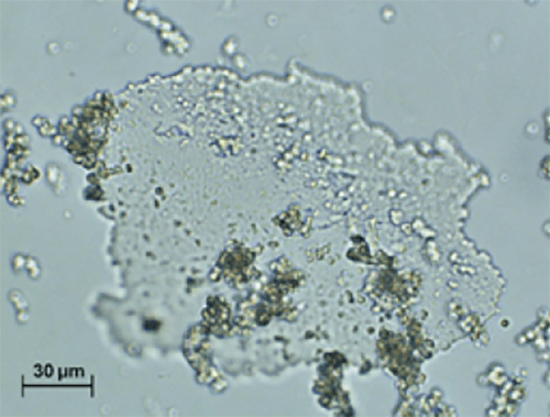 Figura 7. Aglomerados de esferas y placa translúcida irregular de carbonato de calcio (carbapatita)(400X, microscopia Óptica de luz). Fuente: Michel Daudon, Vincent Frochot, Dominique Bazin, Paul Jungers. Crystalluria analysis improves significantly etiologic diagnosis and therapeutic monitoring of nephrolithiasis . Comptes Rendus Chimie. 2016; 19 (11–12): 1514-1526