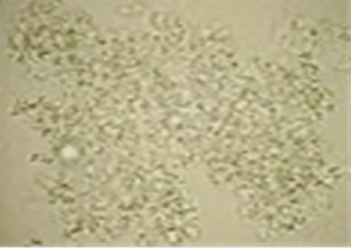 Figura 8. Fosfato de calcio carbonatado amorfo (Fosfato amorfo) (400X, microscopia óptica de luz). Fuente: Mundt, Lillian; Shanahan, Kristy. Graff. Análisis de orina y de los líquidos corporales. México: Panamericana; 2011